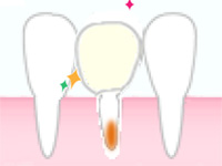 歯の再植療法の説明