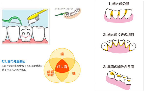 むし歯の発生要因