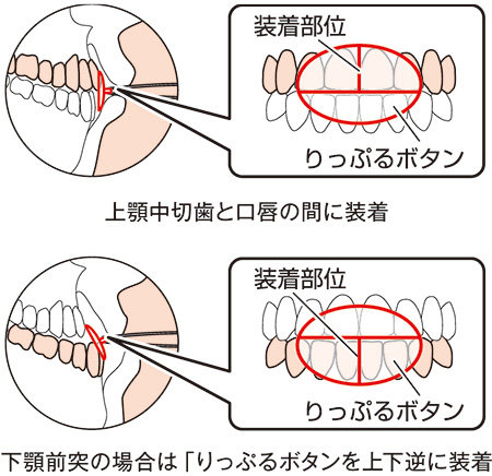 りっぷるくん検査って？｜コラム｜帯広市の歯科・歯医者はますち歯科