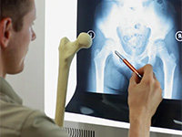 なぜ歯科で骨粗しょう症のリスク判定？